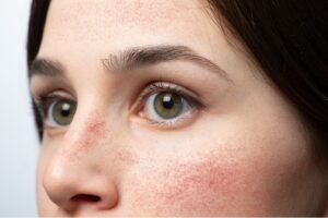 Rosacea