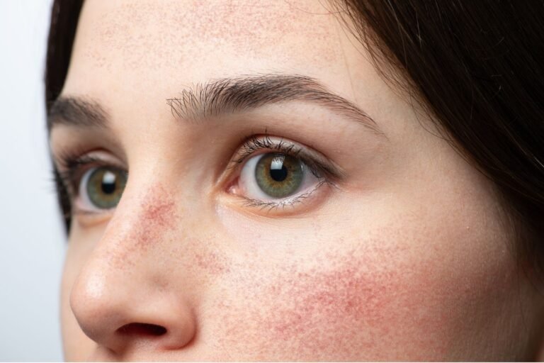 Rosacea